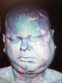 Imagen del paciente al que se le han trasplantado varias partes de la cara.