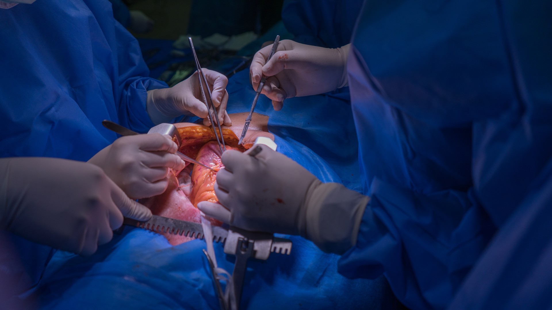 Ir al Video Realizan el primer transplante de corazón en España con un sistema que lo mantiene recibiendo sangre oxigenada permanentemente