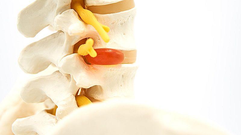 El gallo que no cesa - Médico de guardia: Las causas de la hernia discal - Escuchar ahora