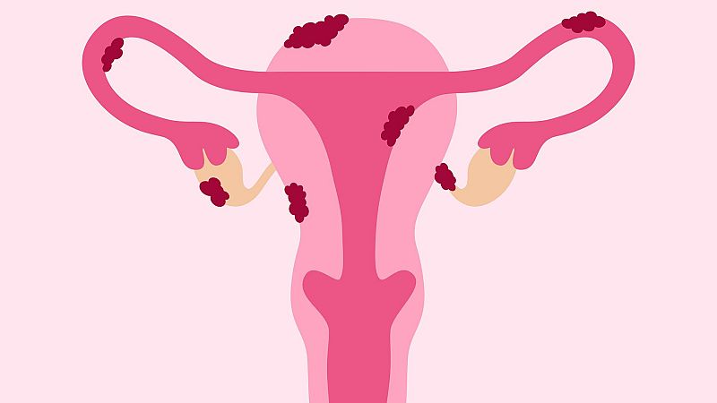 El gallo que no cesa - Las penas se van yantando: La endometriosis y la nutrición