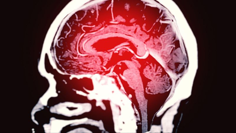 Con bata blanca - Cada seis minutos alguien tiene un ictus en España - 07/06/24 - escuchar ahora