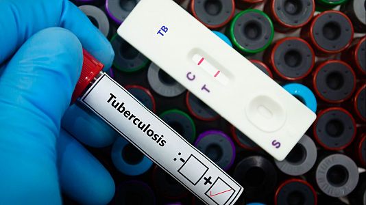 La solución a la tuberculosis podría venir de Zaragoza