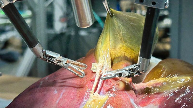 Las Mañanas de RNE con Lara Hermoso - Primera cirugía robótica autónoma comandada por ChatGPT - Escuchar ahora