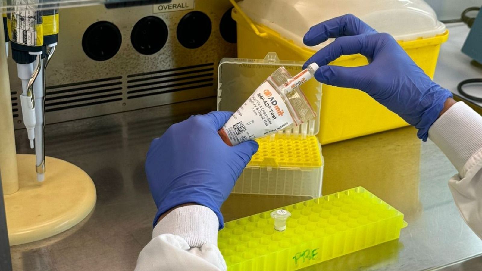 L'Hospital de Bellvitge desenvolupa un biomarcador sanguini per predir l'Alzheimer