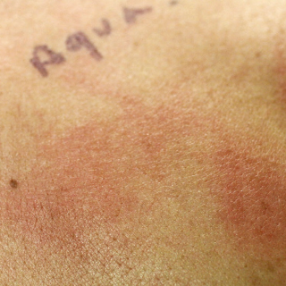 Alergias e intolerancias