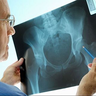 Osteoporosis: de los viejos mitos a los nuevos retos