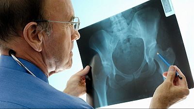 Osteoporosis: de los viejos mitos a los nuevos retos