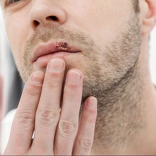 Conviviendo con los herpes