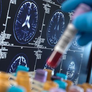 The new test that could boost early diagnosis of Alzheimer's