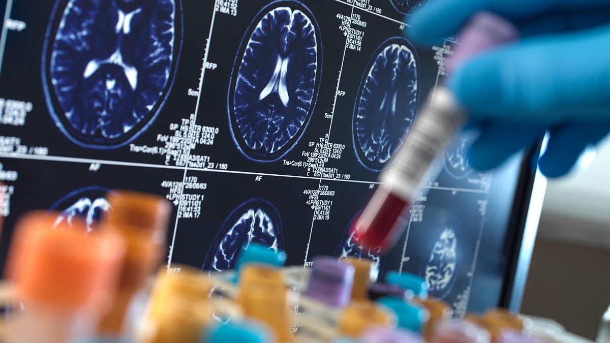 The new test that could boost early diagnosis of Alzheimer's