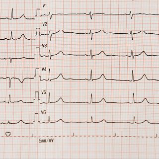 ¿España goza de buena salud cardiovascular?