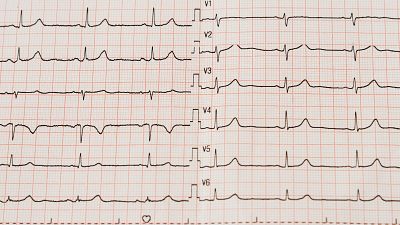 ¿España goza de buena salud cardiovascular?