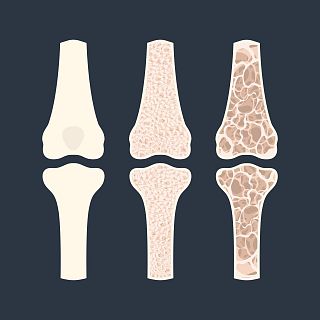 Osteoporosis: cuidar tus huesos
