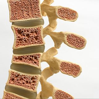 Osteoporosis