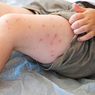 El sarampi�n: causas, riesgos y prevenci�n