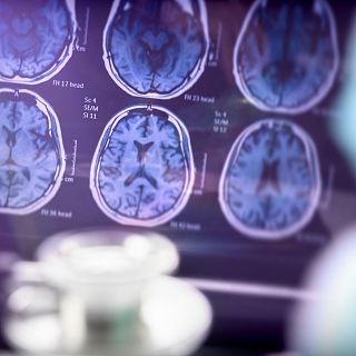 Alzheimer: �c�mo se puede adaptar el sistema de salud a la enfermedad?