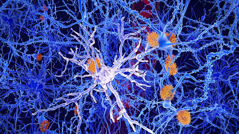 El metabolismo de los astrocitos cerebrales en el alzhéimer - A golpe de bit | Escuchar