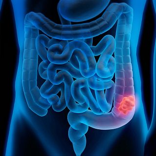 Cáncer de colon: prevención, síntomas y detección