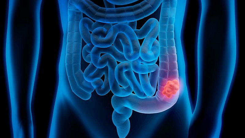 Cuídate con Radio 5 - Cáncer de colon: prevención, síntomas y detección - 23/02/26 - Cuídate con Radio 5 | Escuchar