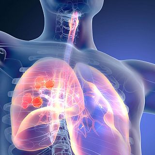 Matí o tarda? Un estudi apunta en quin moment del dia són més efectius els tractaments conta el càncer