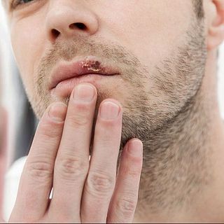 El herpes labial altera neuronas como el alzhéimer