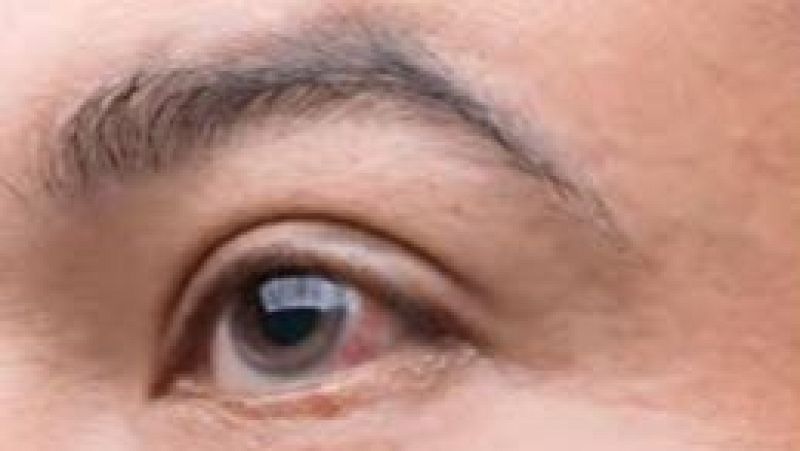 El glaucoma: la principal causa de ceguesa irreversible