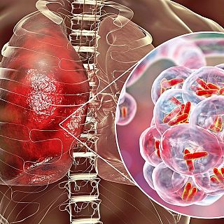 Augmenta la tuberculosi a Espanya