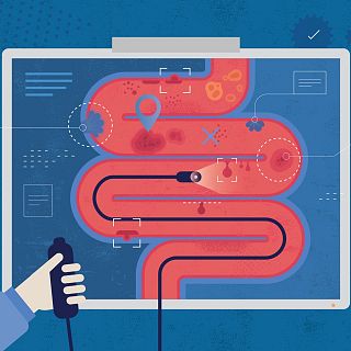 La colonoscopia salva vidas