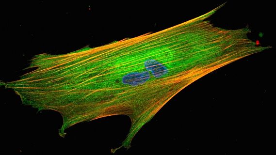 Identifiquen un biomarcador clau per predir el càncer colorectal
