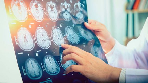 Un ter� dels pacients amb esclerosi m�ltiple experimenta PIRA