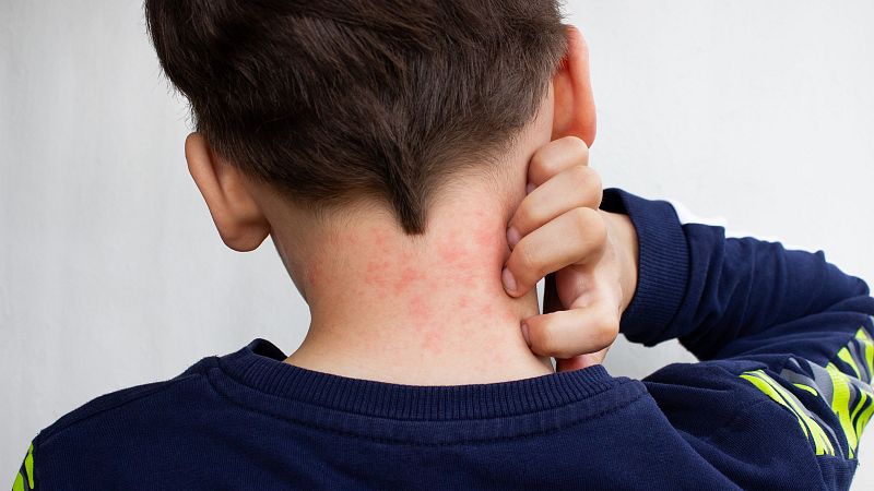 Contra la anafilaxia y alergias 'Cada Minuto Cuenta'