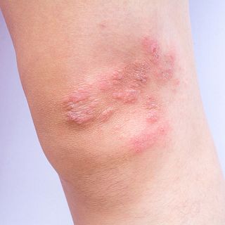 Psoriasis: m�s all� de la piel