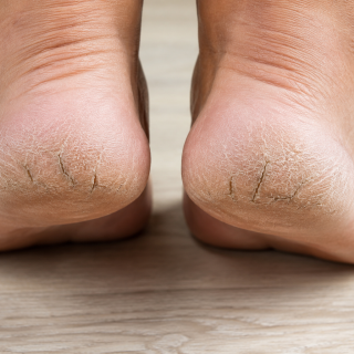 La millor solució per als talons secs i esquerdats