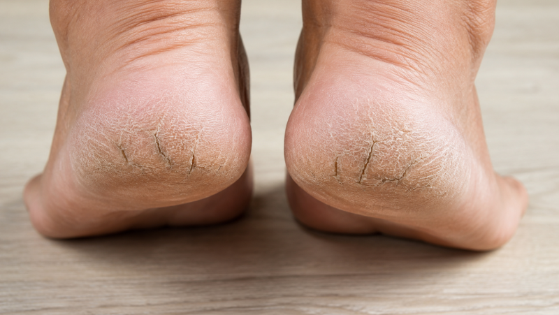 El mat� de R�dio 4 - La millor soluci� per als talons secs i esquerdats - El mat� de R�dio 4 | Escoltar