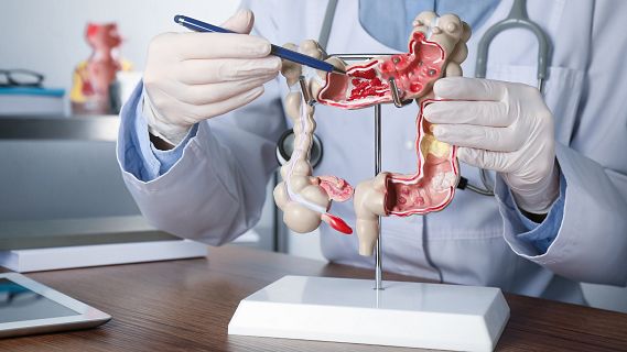 Un bacteri permet predir la recaiguda del c�ncer colorectal preco�ment
