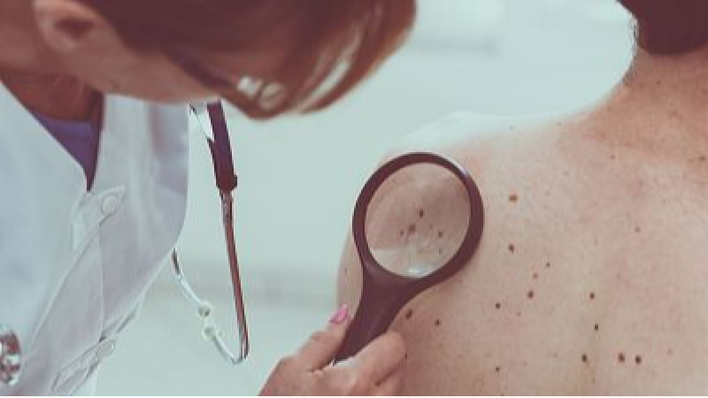 C�ncer de pell: com prevenir-lo, detectar-lo a temps i protegir-nos del sol - Estiu XL | Escoltar