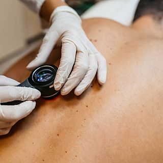 Tratar lesiones de cáncer de piel con resina radioactiva