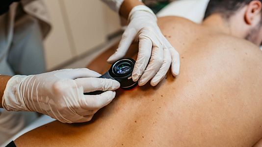 Tratar lesiones de cáncer de piel con resina radioactiva