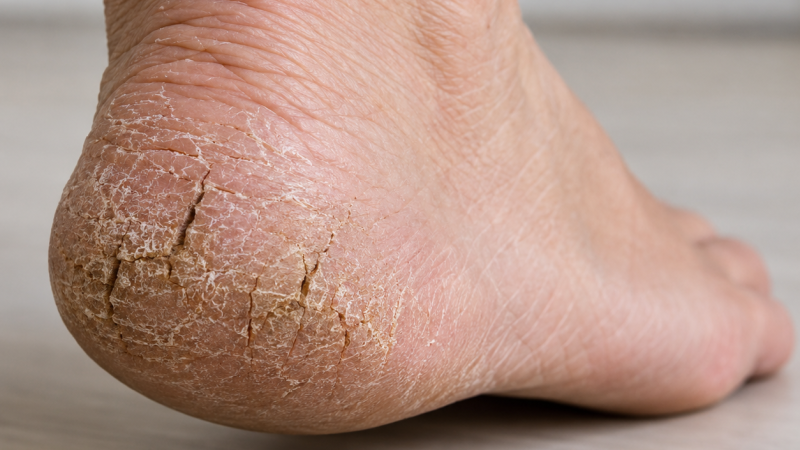 El Mat� de R�dio 4 - Talons esquerdats: causes i el millor remei - El mat� de R�dio 4