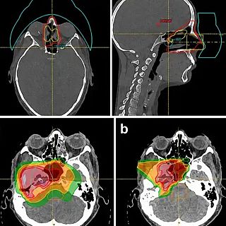 La protonterapia amplía las opciones de tratar el cáncer