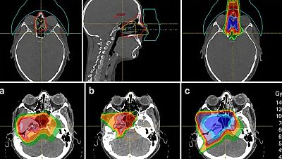 La protonterapia amplía las opciones de tratar el cáncer