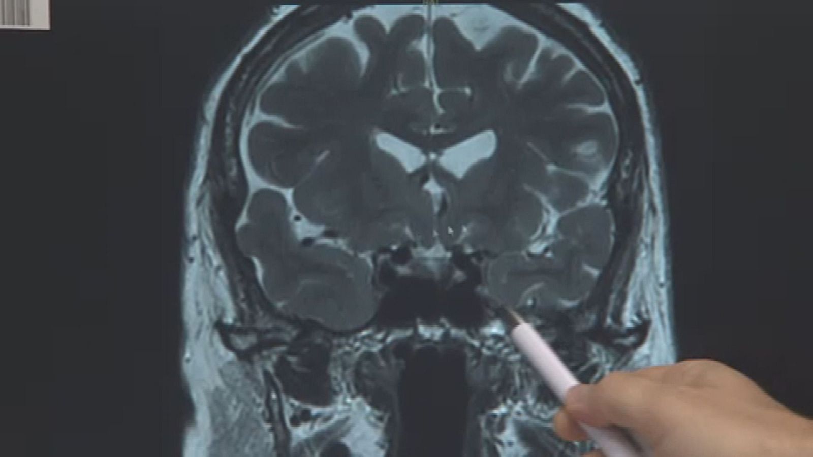 El alzheimer también afecta a edades tempranas - Castilla-La Mancha Informativos
