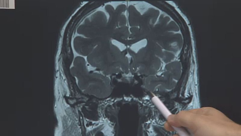 El alzheimer también afecta a edades tempranas - Castilla-La Mancha Informativos