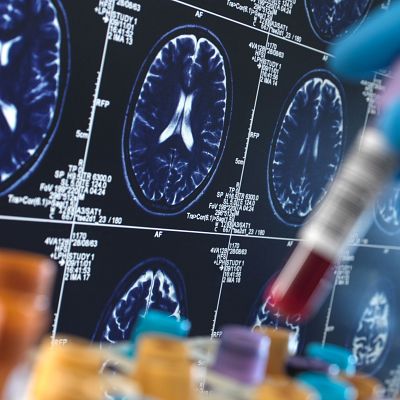 Una mano con guante azul señala una resonancia magnética de un cerebro humano en una pantalla retroiluminada con códigos técnicos, en un entorno de investigación médica.