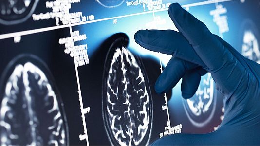 España en la élite de la investigación contra el alzhéimer