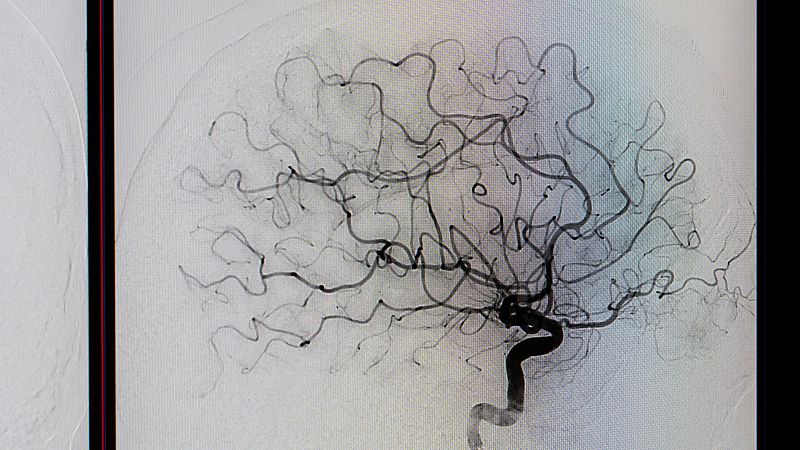 Radiografía médica de una angiografía cerebral en blanco y negro que detalla la ramificación de vasos sanguíneos y arterias sobre un fondo claro.