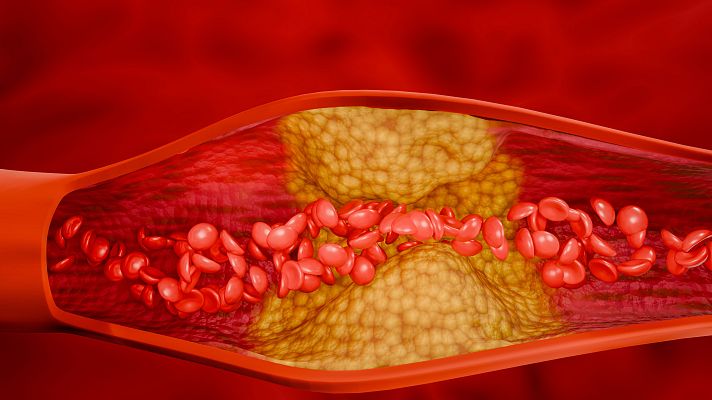 Sección transversal de arteria mostrando placa amarillenta que reduce el flujo sanguíneo de glóbulos rojos.  Sugiere avances tecnológicos en el tratamiento de la ateroesclerosis.