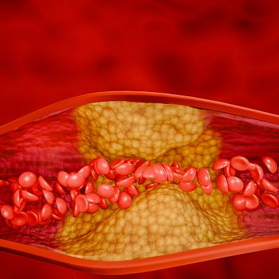 Sección transversal de arteria mostrando placa amarillenta que reduce el flujo sanguíneo de glóbulos rojos.  Sugiere avances tecnológicos en el tratamiento de la ateroesclerosis.