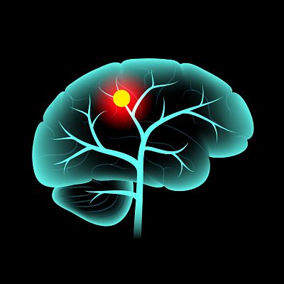 Prevenir la metástasis cerebral y evitar recaídas