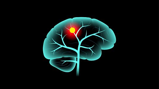 Prevenir la met�stasis cerebral y evitar reca�das